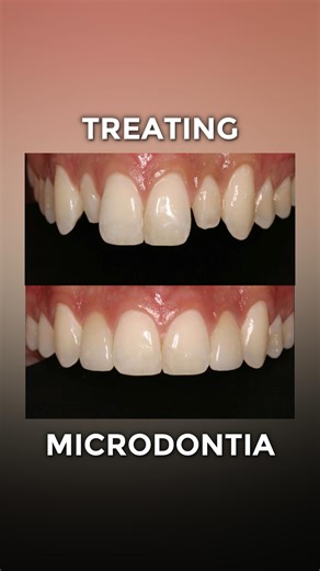 L.A. Dentists Group on Instagram: "Microdontia (teeth that are smaller than average, often called “peg laterals”) can affect your smile’s balance and confidence. The good news? It’s beautifully treatable. At our dental clinic, we use conservative cosmetic solutions like composite bonding and veneers to reshape small teeth, close spaces, and create natural-looking symmetry! No braces No surgery Immediate smile transformation If you’ve ever felt like your teeth look “too small” or spaced out, this
