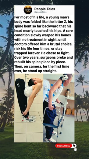 The "folded boy" who lived bent nearly in half. 4 surgeries later, he stood up for the first time.