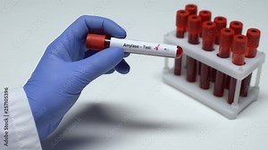 Negative Amylase test, doctor showing blood sample, lab research, health checkup