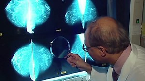 AI-supported mammogram screening increases breast cancer detection by 20%, study finds