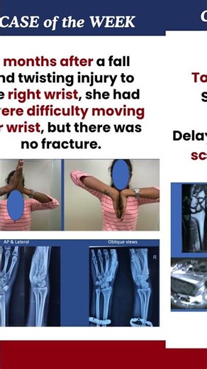 🦴 Late-presentation of wrist joint dislocation (DRU joint) in a 27-year-old gymnast