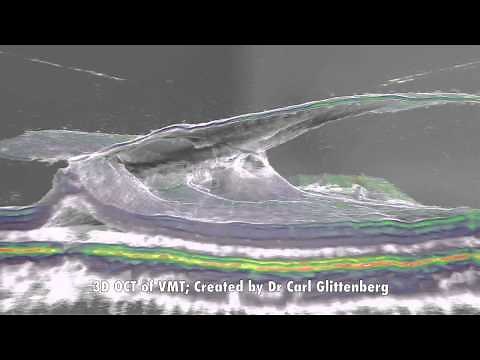 3D OCT of Vitreo-macular traction