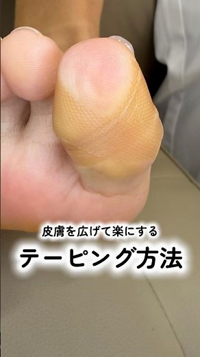 【保存版】初心者でも簡単！巻き爪を楽にするテーピング手順 #フットケア