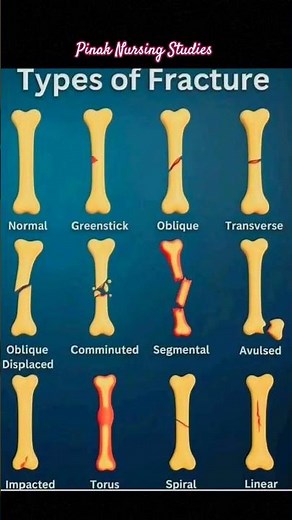 Types of fracture