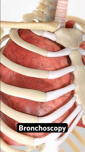 What is Bronchoscopy? (3D Animation)