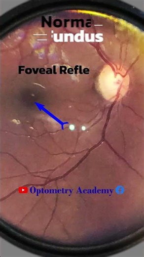 Normal fundus | Normal Retina | Smartphone Fundus Videography | Fundus Photography | Short Video 461