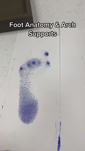 Custom Arch Supports for Foot and Body Pain Relief