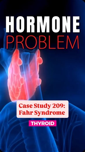 Betsy Grunch, MD | Neurosurgeon on Instagram: "Case Study 209: Fahr Syndrome In Fahr syndrome, abnormal calcification, often involving the basal ganglia, can lead to a wide range of symptoms including movement disorders, cognitive changes, psychiatric symptoms, and seizures. Secondary Fahr syndrome is often linked to metabolic causes, most commonly disorders of calcium regulation such as hypoparathyroidism, sometimes years after thyroid or parathyroid surgery. 📌 Key takeaway: When CT scans show