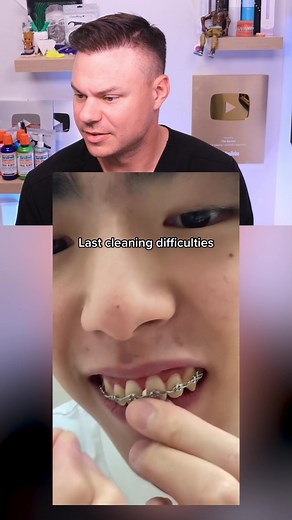 The Final Stage of Braces: What to Expect