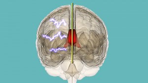 How cutting the brain in half revealed hidden sides of the mind