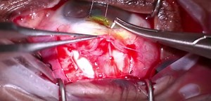 Sandwich Bleb Repair Technique - Eyetube