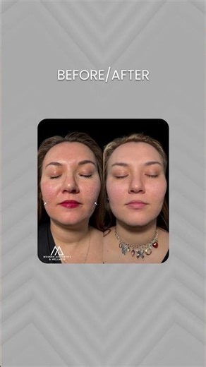 Subcision | Break Free from Acne Scars ✨