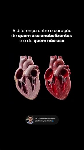 COMO É O CORAÇÃO DE QUEM USA ANABOLIZANTES