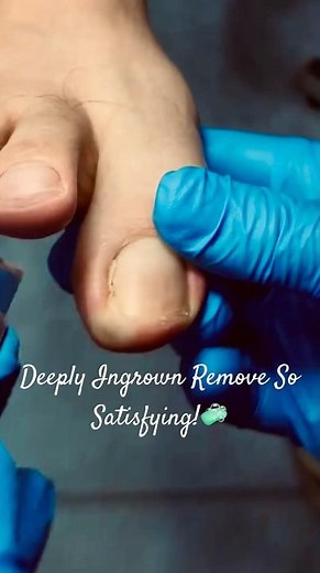 The Ultimate Guide to Fix Toenail Regrowth!