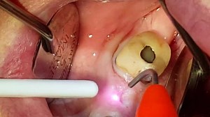 Watch the amazing Picasso Lite cutting tissue off an implant! No blood, no charring, and totally safe! You can't do this with an electrosurge! Check out the Picasso Lite today: http://www.amdlasers.com/?pages=liteplus | AMD LASERS