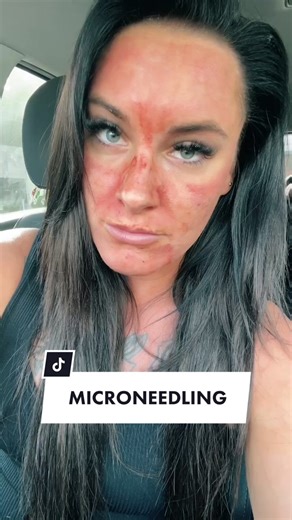 Jenna Jade's Vampire Facial and Microneedling Experience