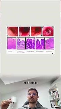 Esófago de Barret y cáncer esofágico