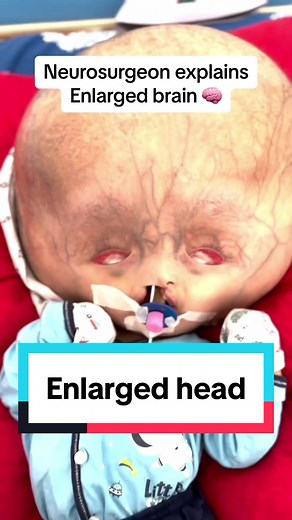 Understanding Hydrocephalus and VP Shunt Treatment