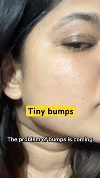 Whiteheads skin like bumps on face reequil zinc sunscreen mineral review #shorts #sensitiveskin