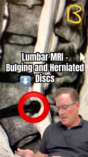 This Herniated Disc Looks PAINFUL
