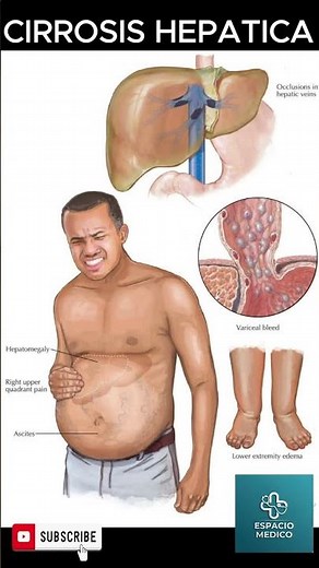 CIRROSIS HEPATICA #gastroenterología #fisiopatologia #médico #fisiologia #serums #residentes