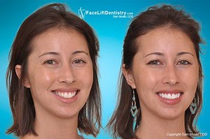 Correcting Long or Large Looking Front Teeth