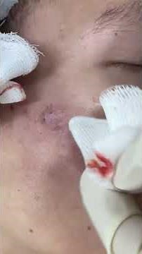 Nặn mụn nhọt ở má