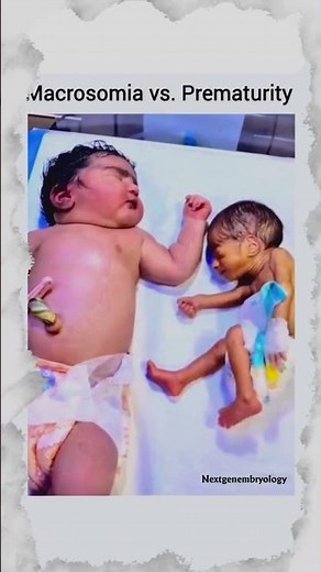 Macrosomia vs. Prematurity — What causes this? #shorts #youtubeshorts