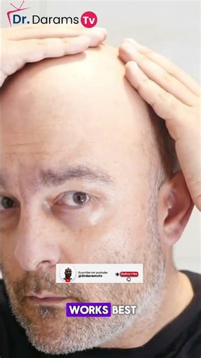 Why Men Lose Their Hair: The Truth No One Tells You