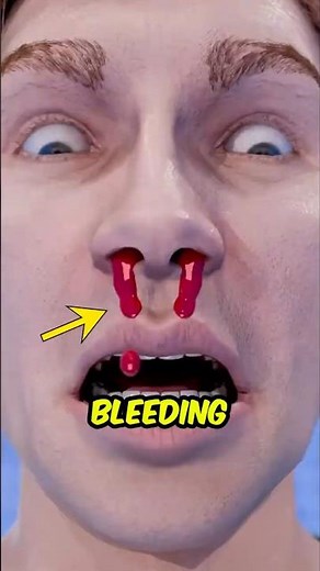 Why Nosebleeds Happen Out of Nowhere