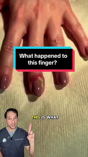 Understanding Paronychia: Common Hand Infections Explained