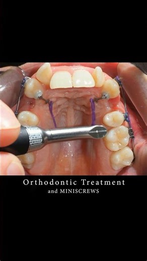 Braces can change your smile with MINISCREWS! #braces #orthodontist #smilemakeover #dentist