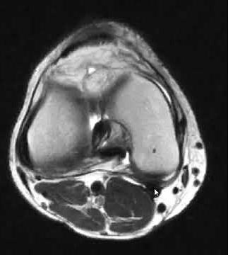 Pes anserine complex and semimembranosus on MRI knee