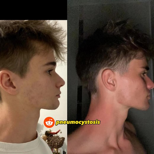 Transform your jawline with mewing techniques