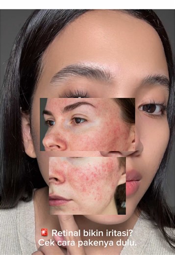 Tips Pemakaian Retinal untuk Kulit Kering