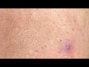 Acne Treatment Nhat Bang #22
