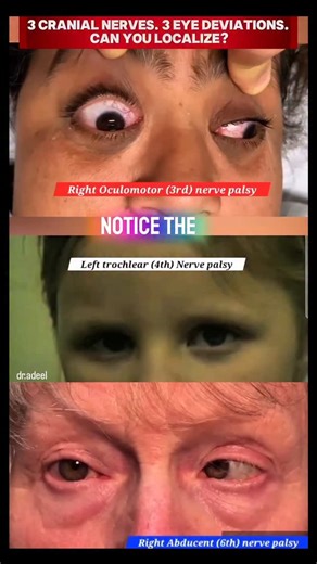 CN III vs CN IV vs CN VI Palsy 👁️ | Can You Localize the Lesion? Compare 3rd, 4th, and 6th cranial nerve palsies. CN III: ptosis, dilated pupil, “down & out.” CN IV: vertical diplopia with head tilt. CN VI: inability to abduct. Recognize patterns and localize fast. #CranialNerves #CN3 #CN4 #CN6 #OculomotorPalsy TrochlearPalsy | Adeel Ur Rehman