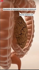 Illustration of impacted stool|Human anatomy art