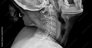 Spinal Precision: Cervical Lateral X-ray Revealing Neck Anatomy.
