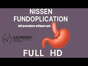 Nissen Fundoplication – Full Procedure Without Cuts | Full HD