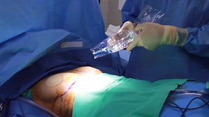 Breast Augmentation and Areola Reduction (GRAPHIC)