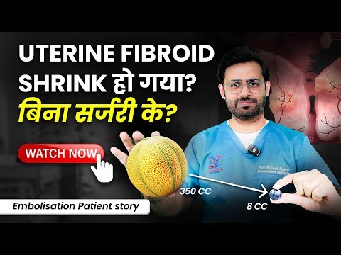 Fibroid Treatment WITHOUT Surgery | UFE (Uterine Fibroid Embolisation) Success Story Explained