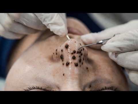 Extreme Blackhead Removal on Nose | Deep Pore Extraction ASMR