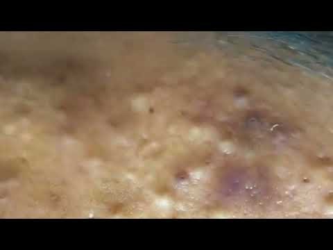 cysts and blackheads this week , blackheads , cystic acne extraction , big blackheads #001