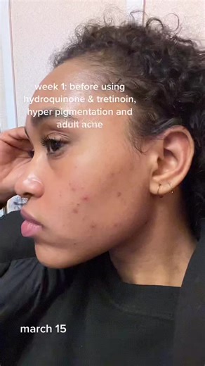 1.5-Month Hyperpigmentation & Adult Acne Update | Skincare Journey