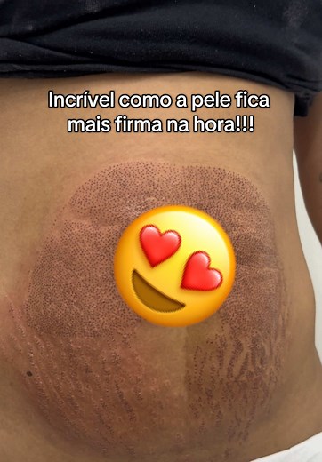 Jato de Plasma: Redução da Flacidez Abdominal em 90 Dias