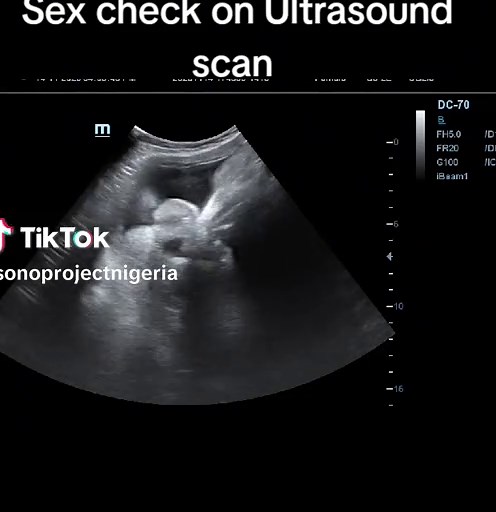 Understanding Ultrasound Gender Prediction Techniques