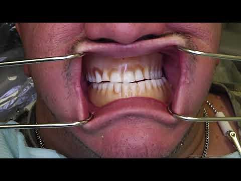 CDJ: 1) Preliminary Visit - Alginate Impressions