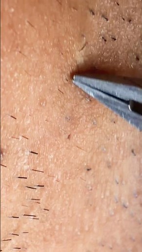 #plucking #tweezer #blackheads #beard #facialhair