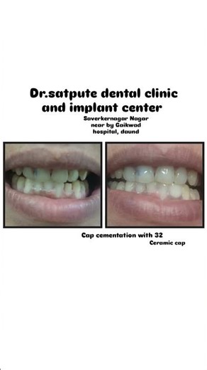 Treatment- ceramic cap cementation